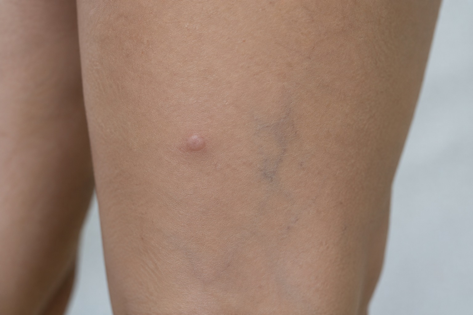 Close view of skin on a thigh with a small ingrown hair bump under the surface